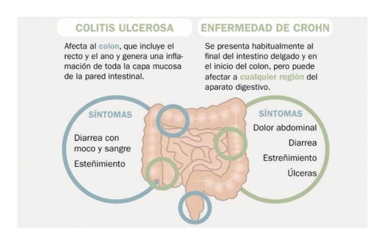 Enfermedades asociadas a la colitis ulcerosa